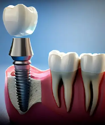 dental implants in noida