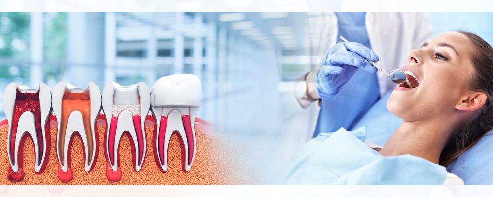 root canal treatment in noida